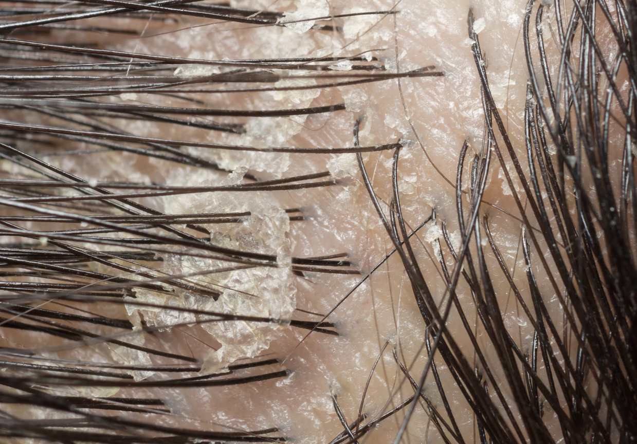 Dandruff in the hair and scalp. Macro shot