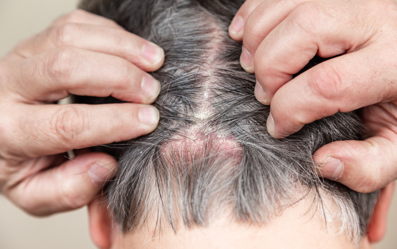 Head Psoriasis Disease 